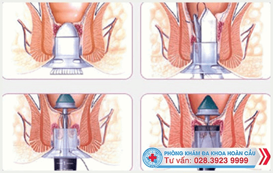 Cần điều trị rò hậu môn bằng phương pháp tiên tiến