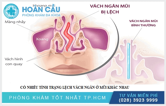 Có nhiều dạng lệch vách ngăn mũi khác nhau