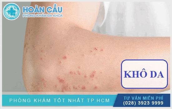 Nổi chấm đỏ trên da và ngứa có thể là do khô da