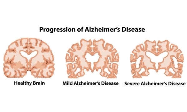 Tips Mengurangi Resiko Alzheimer