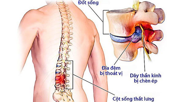 Thoát vị đĩa đệm thắt lưng