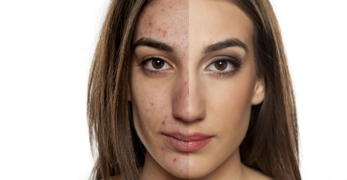 Eczema Treatment Torrance CA