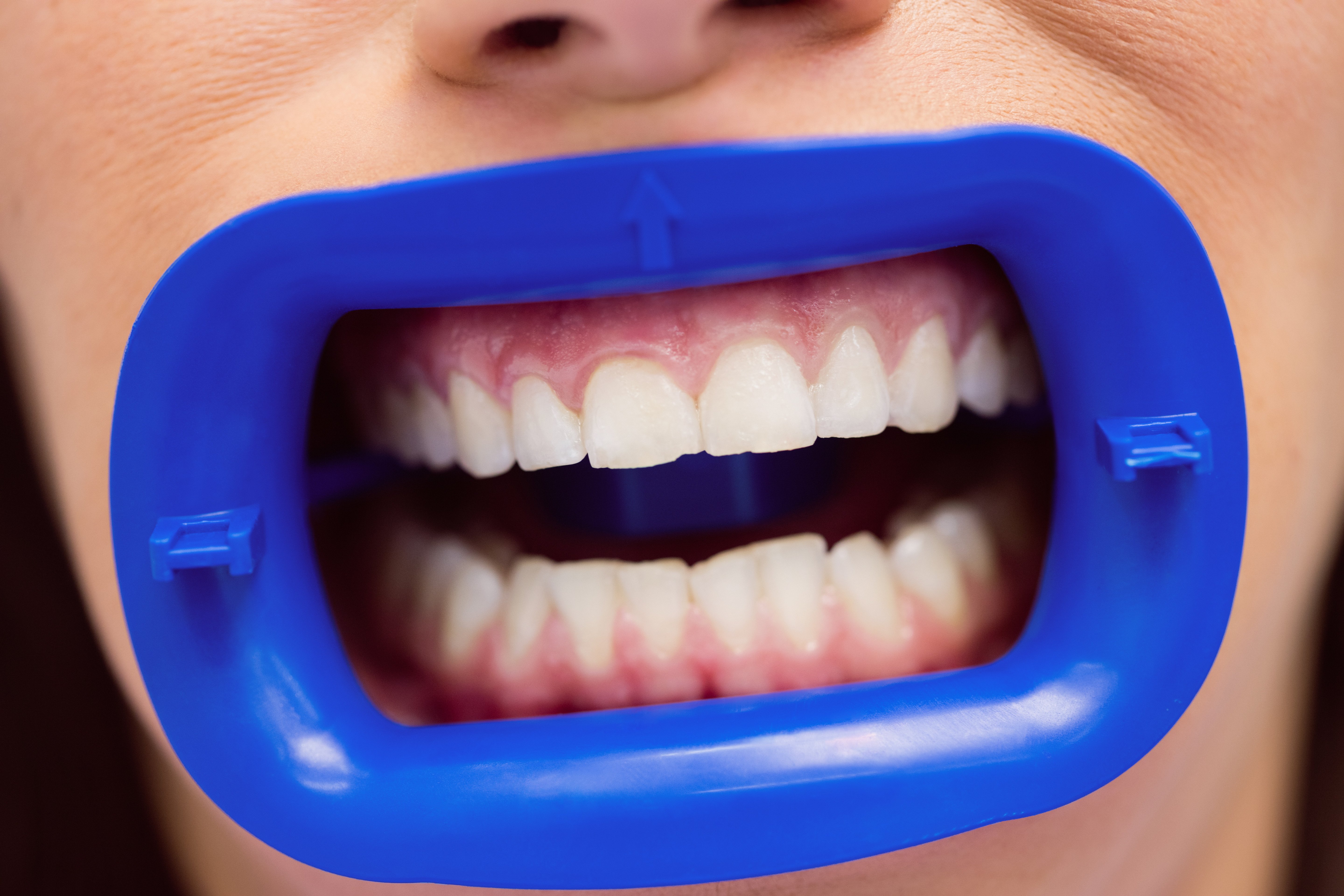 избелване на зъби в кабинет от стоматолог
