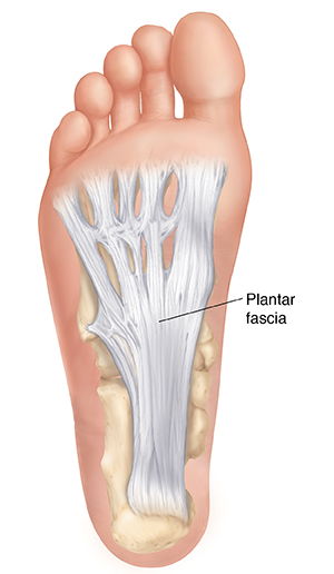 Plantar Fasciitis