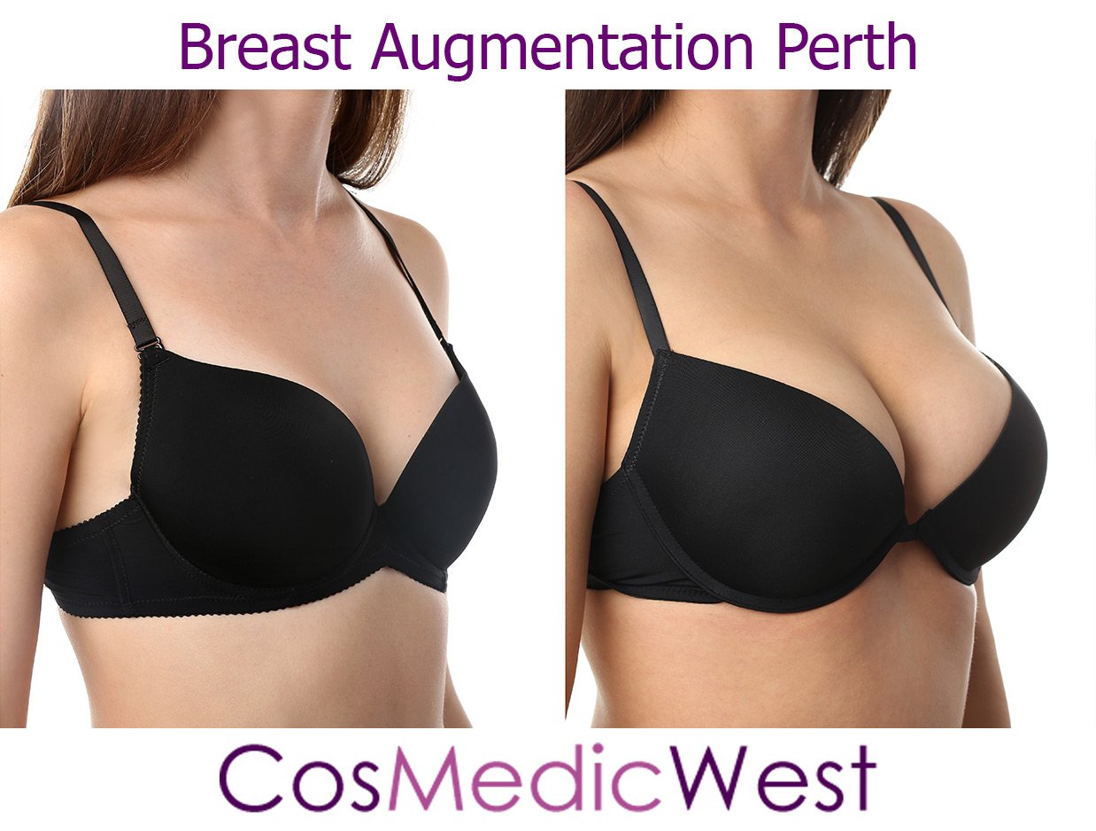 How Tight Should My Sports Bra Be After Breast Augmentation? - Breast  Augmentation in Perth