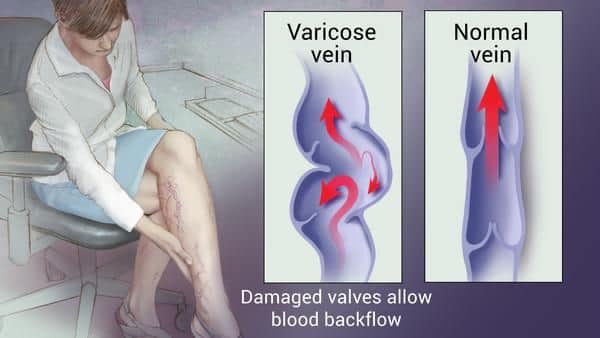 Varicose Veins Dubai