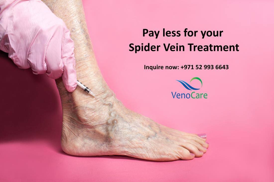 Spider Veins Treatment