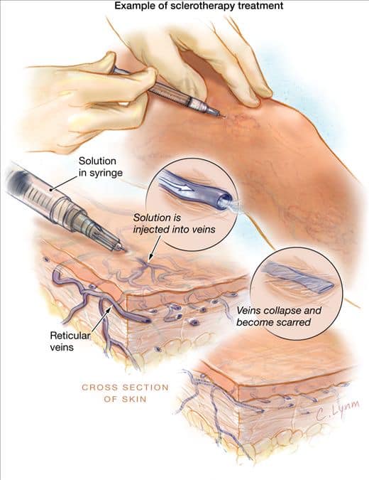 Varicose Veins Sharjah