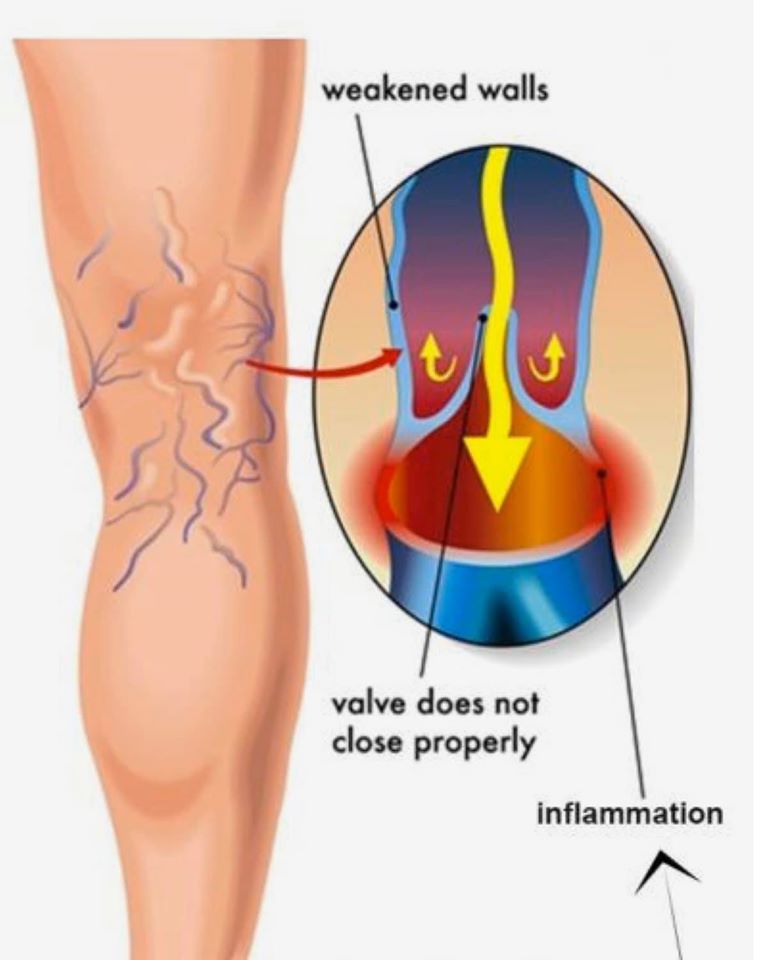 varicose veins clinic