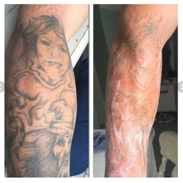 Pain-free Tattoo Removal