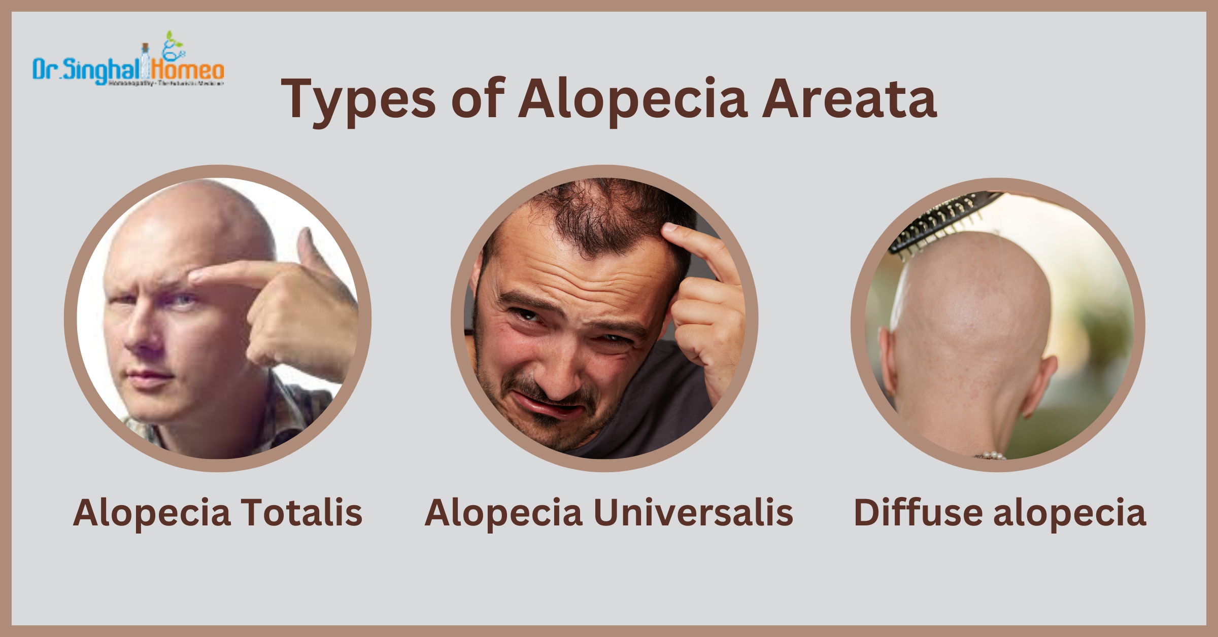 Homeopathic Medicine for Alopecia Areata