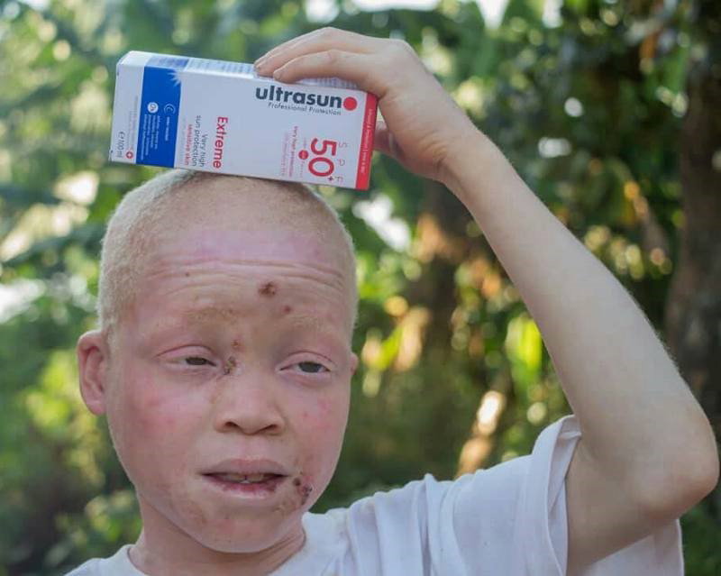 A boy with albinism holding his pack of sunscreen.