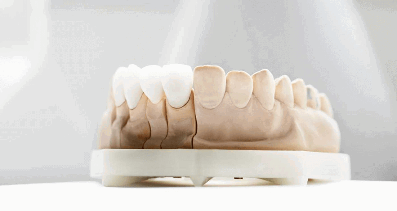 houston-veneer-dentist-1280x683