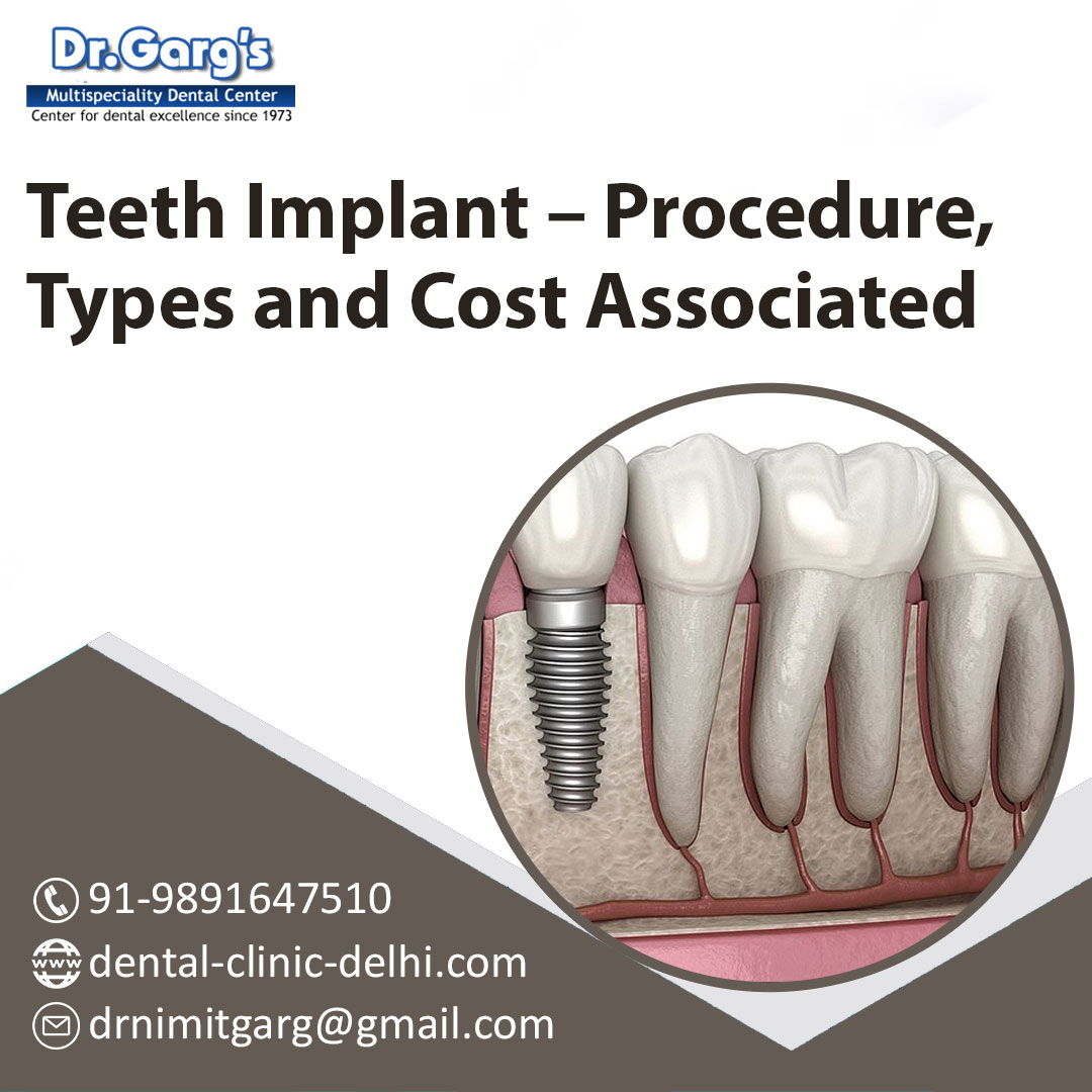 Dental Implants