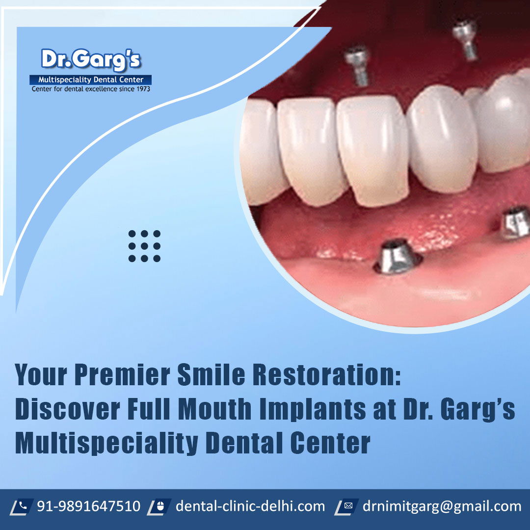 Your Premier Smile Restoration: Discover Full Mouth Implants at Dr. Garg’s Multispeciality Dental Center