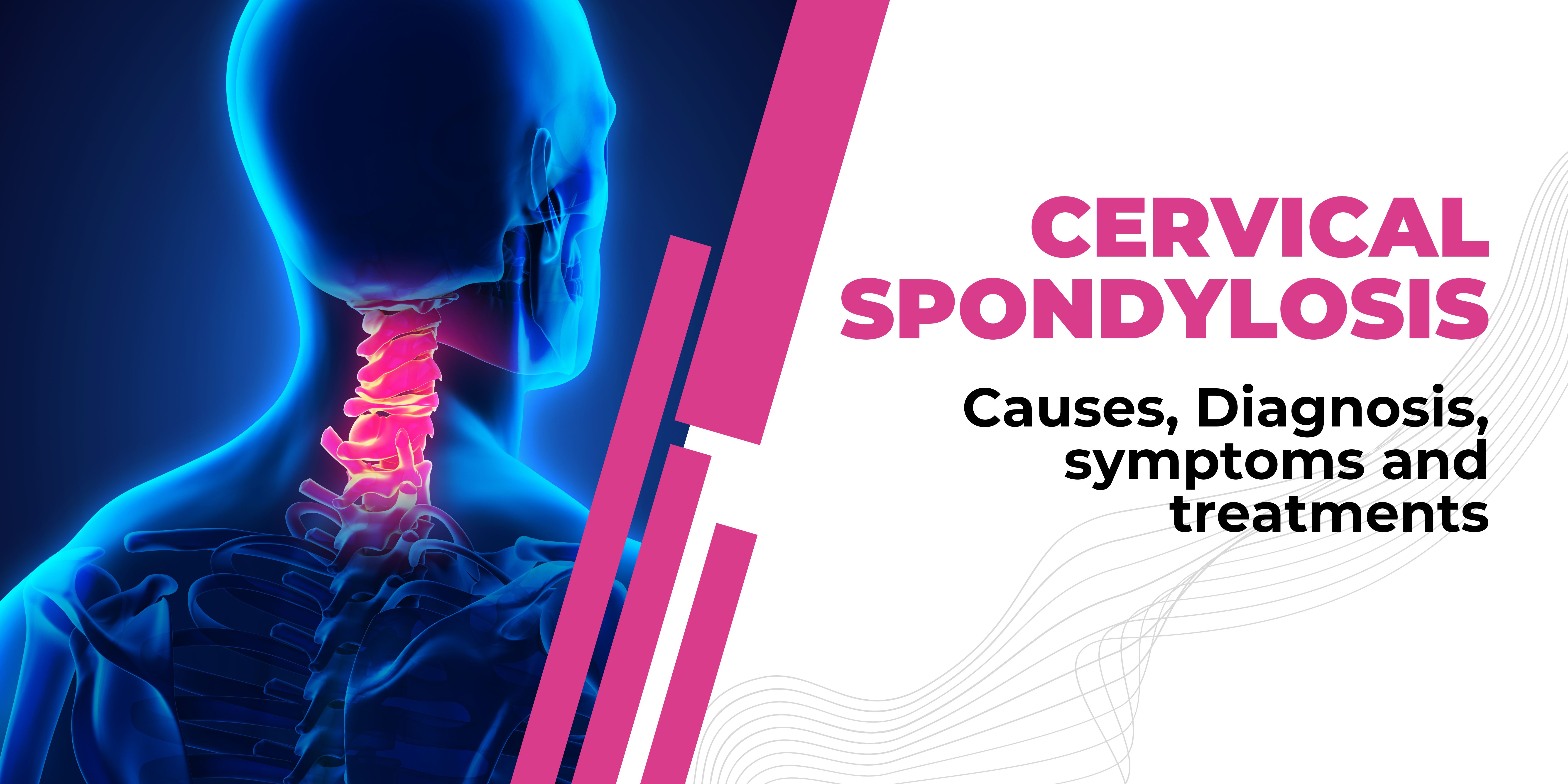 Cervical spondylosis: causes, Diagnosis, symptoms & treatments 