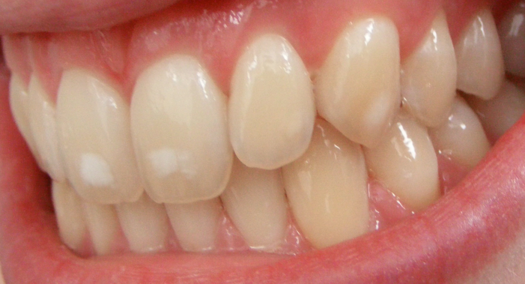 Dental_fluorosis_mild-1024x554
