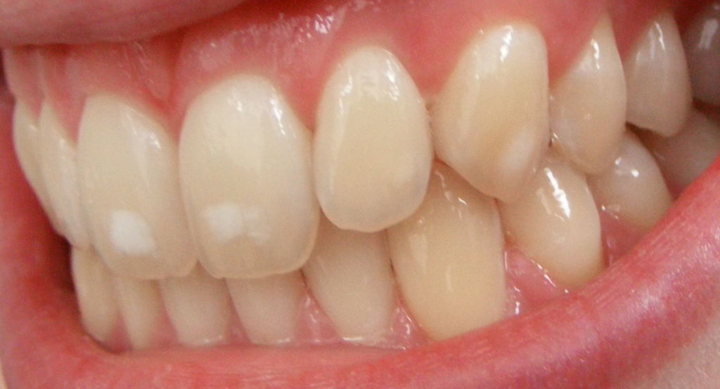 Dental_fluorosis_mild-1024x554