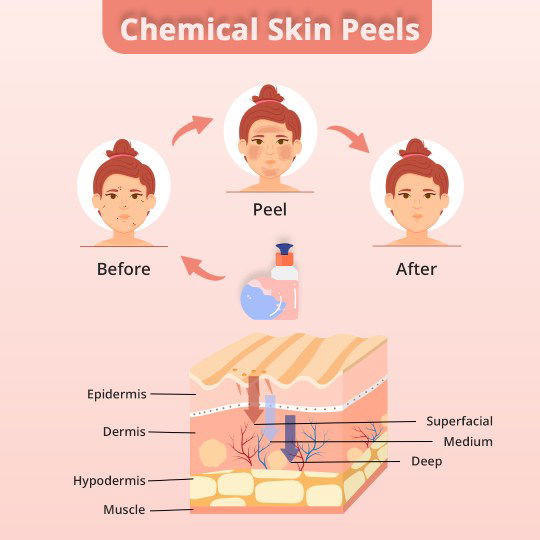 chemical peels