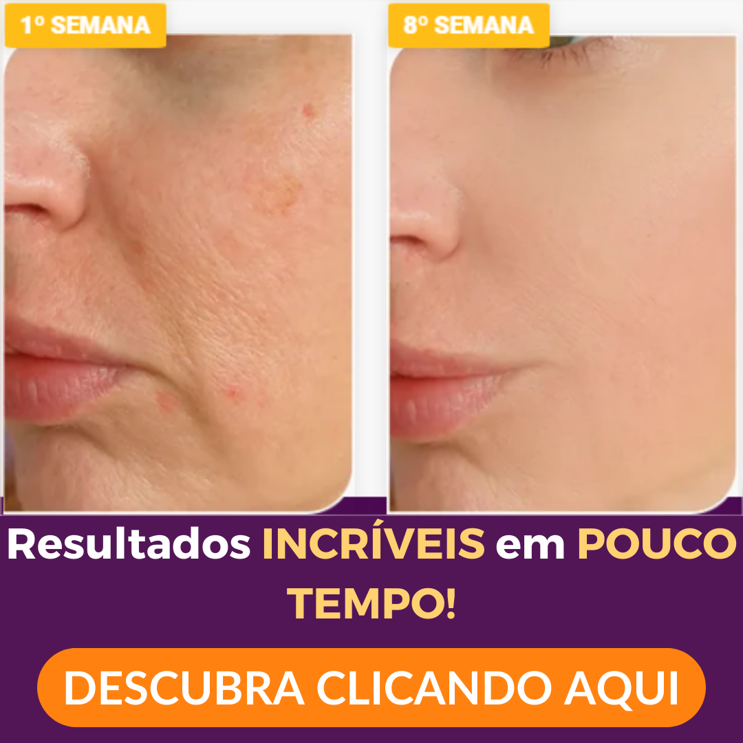 Dream Colágeno Solúvel antes e depois
