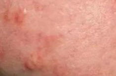 Raised Acne Scar