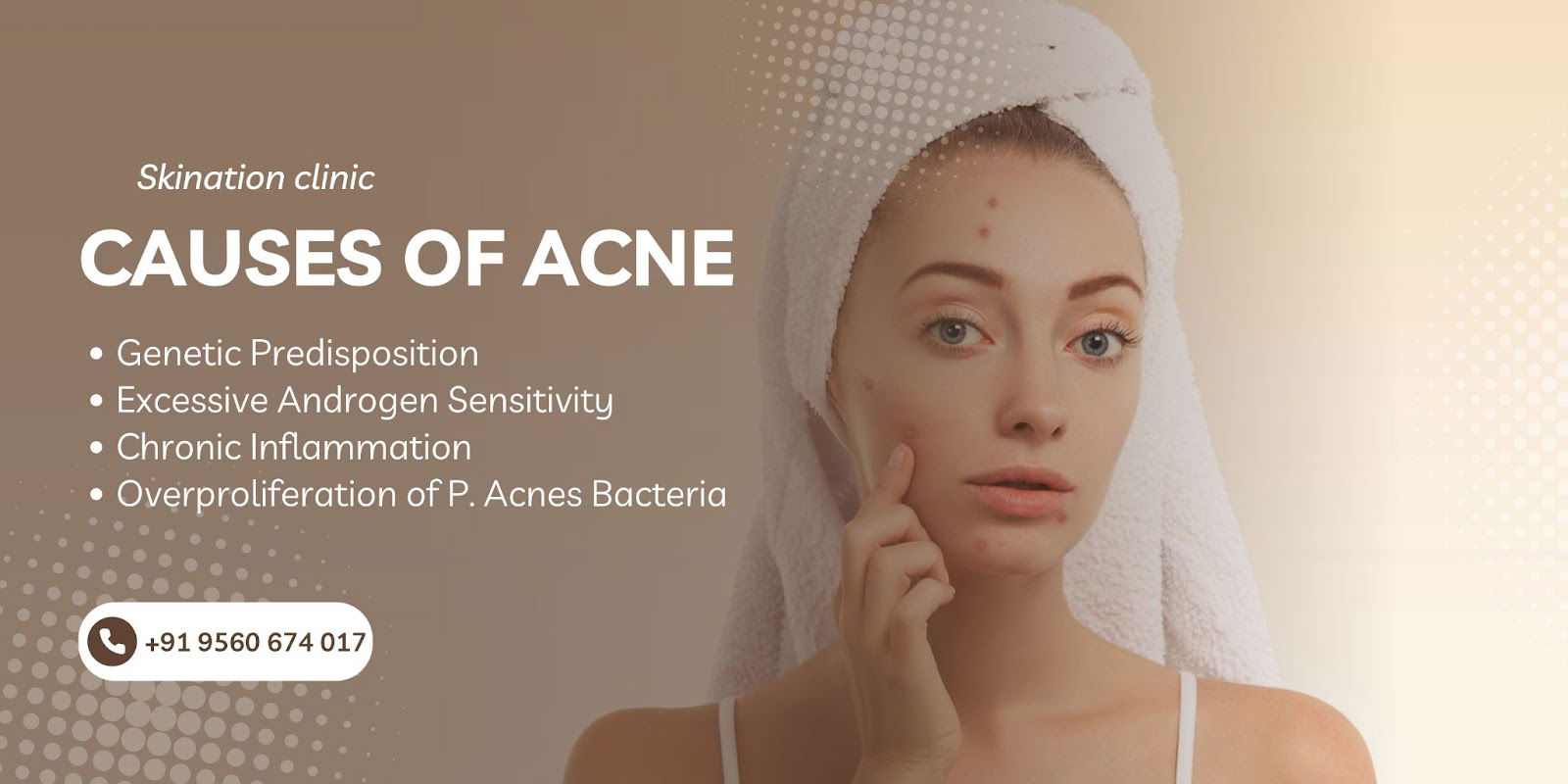 Causes Acne