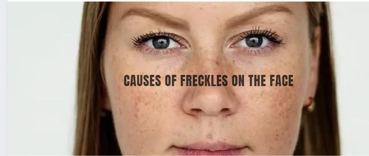 Causes of Freckles on the face