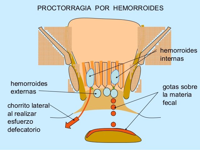 proctorragia