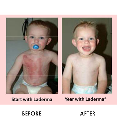 Laderma