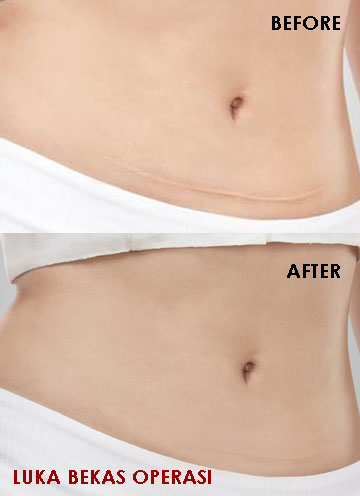 Laderma