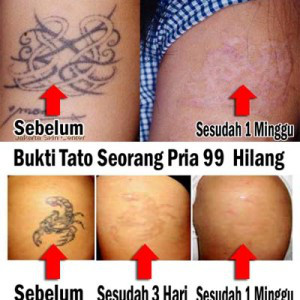 Image result for testimoni tattonox
