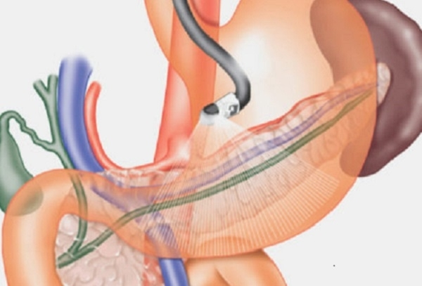 Nội soi dạ dày có hại không? 
